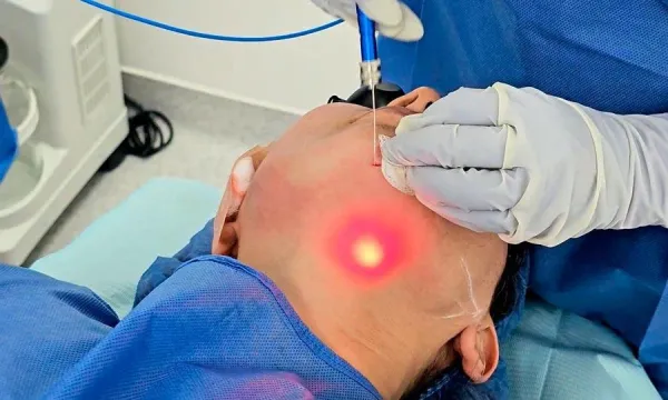 Action de la microfibre laser Endolift sous le menton
