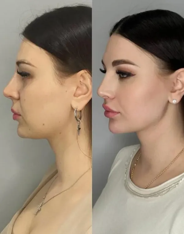 Structuration de la mâchoire et jawline