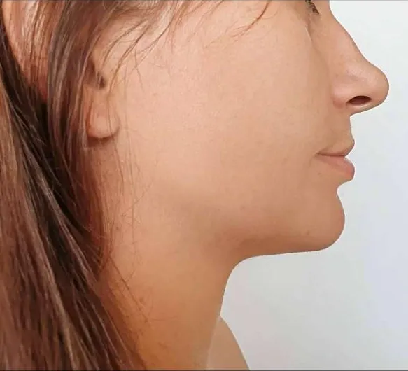 Profil après protocole Saphir V-Line Sculpt™ : angle cervico-mentonnier redessiné et mâchoire redéfinie