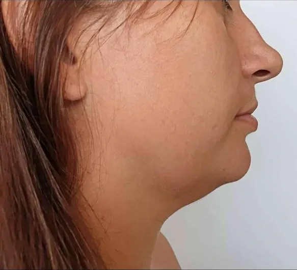 Profil avant traitement : angle cervico-mentonnier ouvert et ligne mandibulaire peu marquée