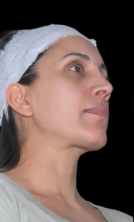 Bas du visage avant Endolift : ovale relâché et ligne mandibulaire peu marquée