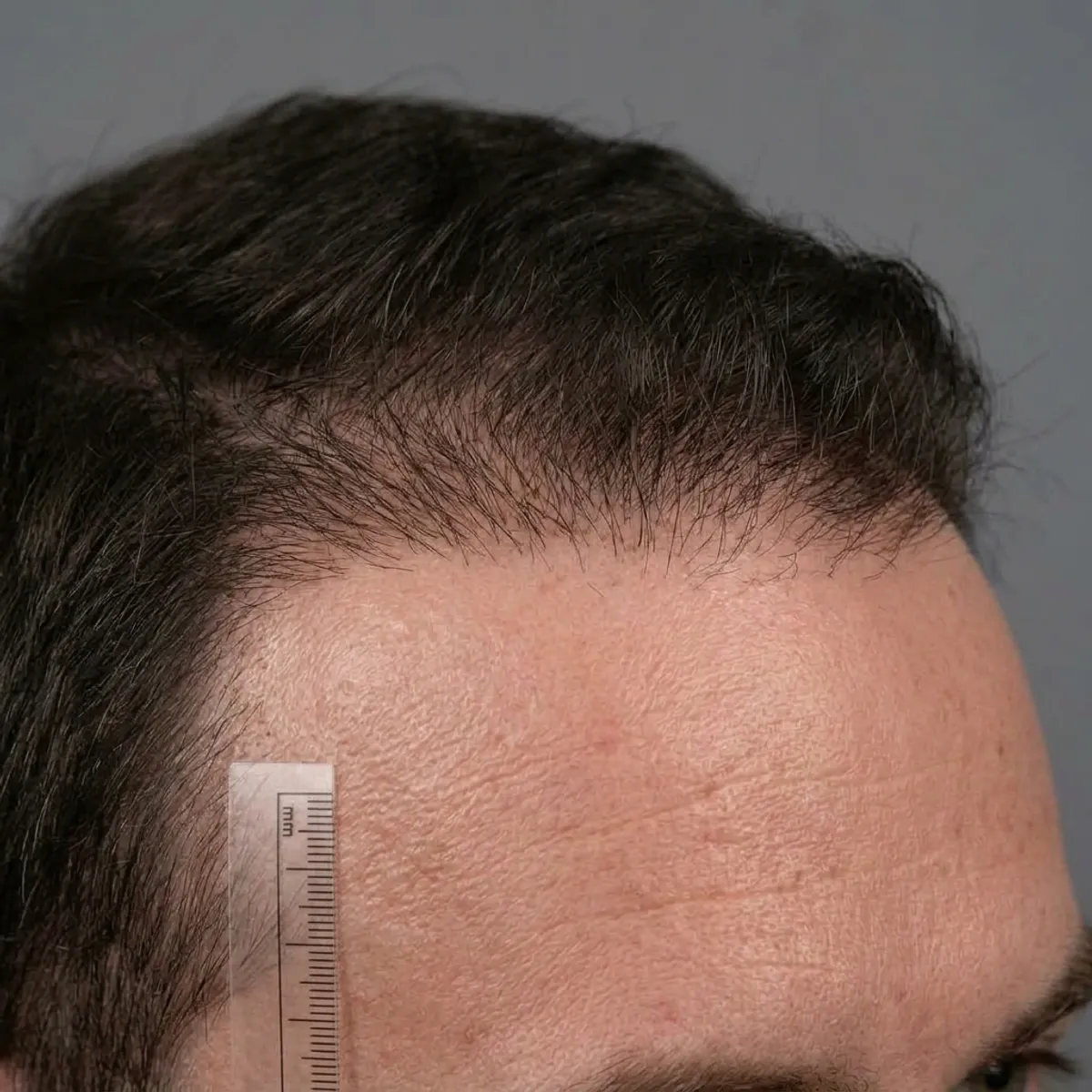 Après greffe de cheveux, lisière frontale DHI, 10 mois