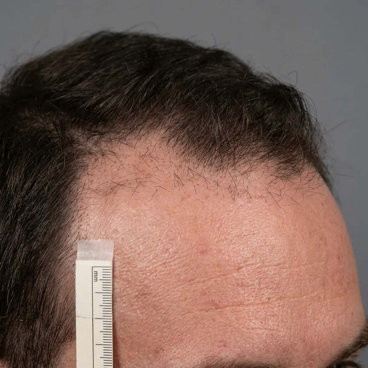 Avant greffe de cheveux, lisière frontale DHI