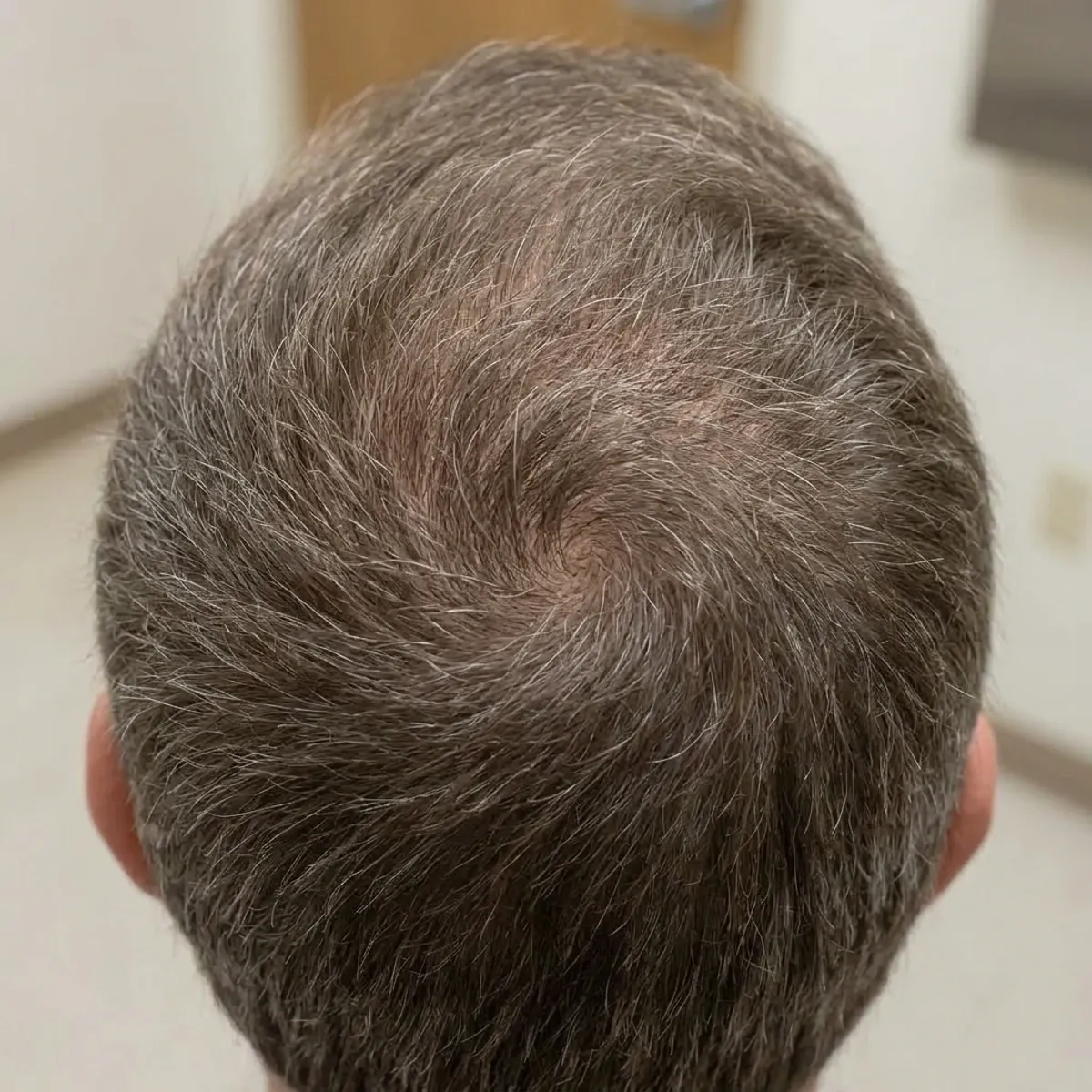 Après greffe de cheveux, vertex densifié, 12 mois